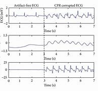 Image result for CPR ECG Reading