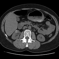 Image result for RT Kidney Mass