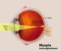 Image result for Myopia