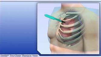 Image result for Uresil Thoravent Removal