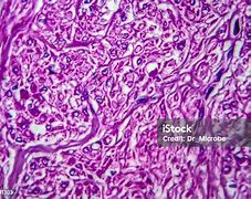 Image result for Large Uterine Fibroid