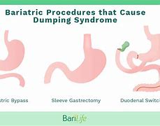 Image result for dumping_syndrome