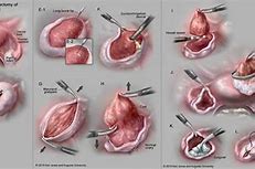 Image result for ovary dermoid cysts remove