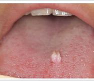 Image result for Papillomavirus On Tongue
