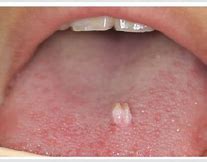 Image result for Papillomavirus On Tongue