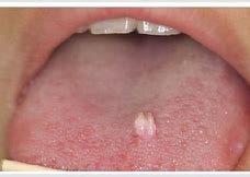 Image result for Tongue Papilloma