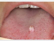 Image result for Papilloma Warts