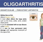 Image result for Oligoarthritis