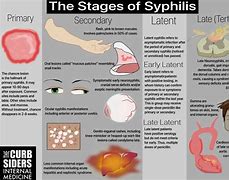 Image result for Stages Trichomoniasis