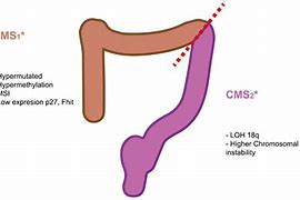 Image result for Colon Cancer Tumor Size