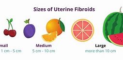 Image result for 7 Cm Fibroids in Uterus