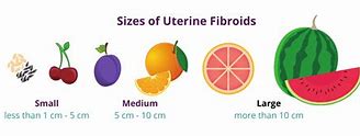 Image result for Fibroids in Uterus Size