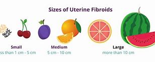 Image result for 10 Cm Uterine Fibroid