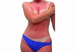 Image result for SunBurn Cancer