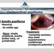 Image result for Sessile Papilloma