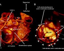 Image result for Ostium of the Profunda