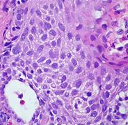 Image result for Squamous Cell Skin Cancer Lip
