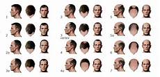 Pattern Bladness Hair Loss In Men