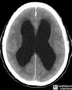 Image result for Hydrocephalus X-ray