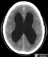 Image result for Hydrocephalus Imaging