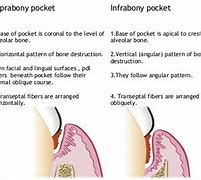 Image result for Infrabony Pocket
