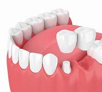 Image result for 4 Types of Dental Bridge