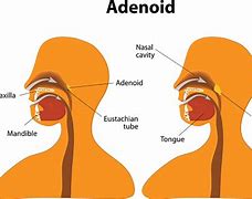 Image result for adenoudes