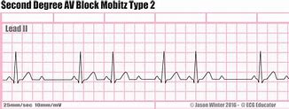 Image result for Mobitz Type 2 Heart Block Treatment