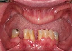 Image result for Severe Upper Jaw Bone Loss