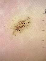 Image result for Dermoscopy Verruca