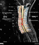 Image result for Cervical Spine Top-Down View in MRI