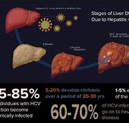 Image result for Liver Cancer Hepatitis B and C