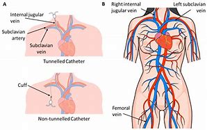 Image result for Dialysis Cath
