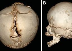 Image result for Craniosynostosis Scar