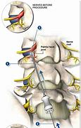 Image result for Rhizotomy Procedure for Neck Pain