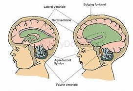 Image result for Hydrocephaly