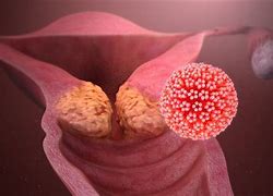 Image result for Cervical Cancer Human Papillomavirus