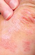 Eczema 的图像结果