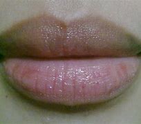 Image result for Juvederm Lips Before and After