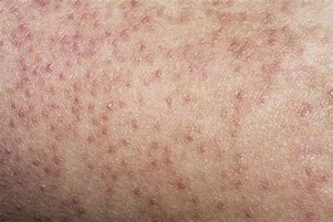 Image result for Keratosis Pilaris Causes