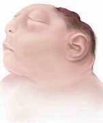 Image result for Anencephalic Pregnancy