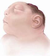 Image result for Child Born with Acrania