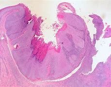 Image result for Molluscum Contagiosum On Black and African American Skin