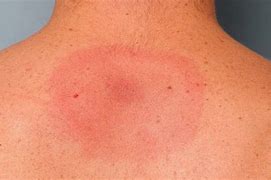 Image result for Diagnosing Lyme Disease