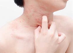 Image result for Skin Rash Caused by Food Allergy