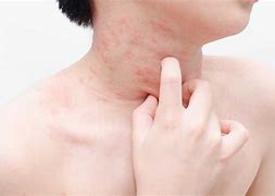 Image result for Skin Rash Caused by Food Allergy