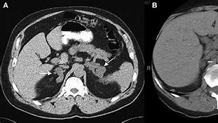 Image result for Nodule On Adrenal Gland