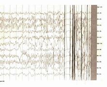 Image result for Polyspikes EEG