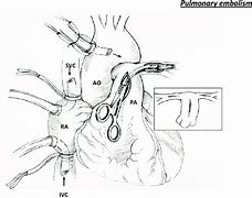 Image result for Arteriotomy