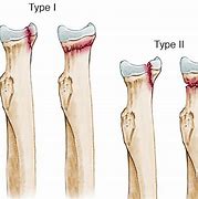 Image result for Type 1 Radial Head Fracture
